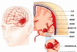 （sah是什么病的简称）什么是蛛网膜下腔出血?病因和临床特点有哪些?如何早防早治?