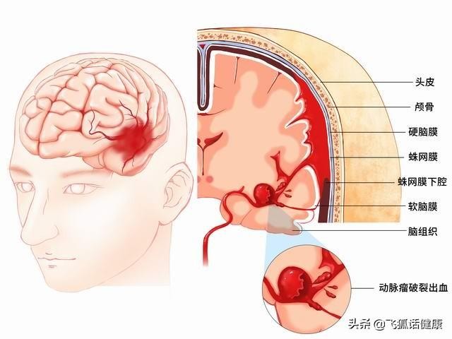 这几个动作，可能让血压瞬间增高!心内科专家:教你几招稳住血压|燕赵健康大讲堂（能让血压瞬间升高的办法）