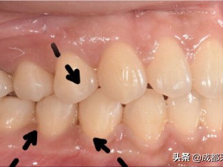 （正常牙齿咬合）怎样判断牙齿咬合功能是否正常?