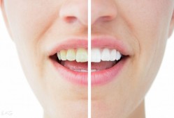 （贴面牙齿<strong>价格</strong>多少钱一颗）牙齿做贴面多少钱一颗?瓷贴面美白对牙齿有损害吗?