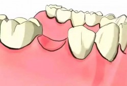 （种植牙齿）【杏林微科普】种植牙——人类的第三副牙齿