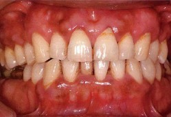 （牙齿酸软怎么办）牙齿酸软怎么办?口腔专家给出<strong>最</strong>有效的解决办法