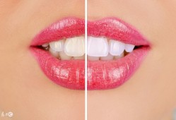 （瓷贴面牙齿多少钱一颗）牙齿<strong>做</strong>贴面多少钱一颗?瓷贴面美白对牙齿有损害吗?