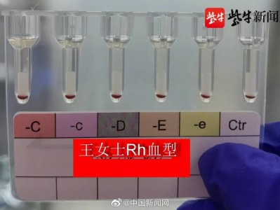 （fy是什么缩写）真相与常识(99)|全球不足50例的“黄金血”是什么血型?珍贵在哪?如何产生?