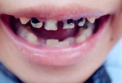 （小孩牙黑是什么原因引起）孩子满嘴“小黑牙”，不是糖果惹的祸，而是与这3个原因相关
