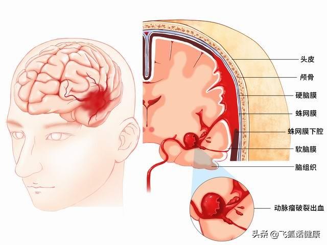 （sah是什么病的简称）什么是蛛网膜下腔出血?病因和临床特点有哪些?如何早防早治?  第1张