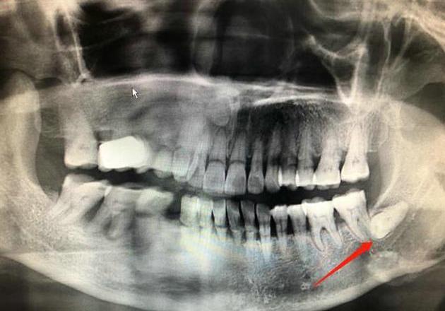 智齿什么梗 现男友问周冬雨两边都拔了吗，先不要笑，智齿什么情况下需要拔  第7张