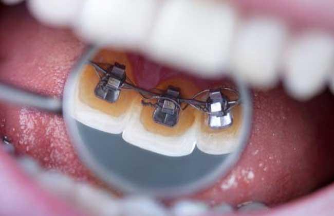 （包牙齿多少钱一颗）牙套价格多少钱一个 牙套有哪些种类  第1张