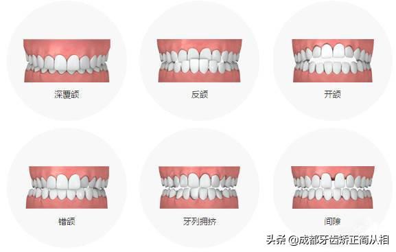 （正常牙齿咬合）怎样判断牙齿咬合功能是否正常?  第2张