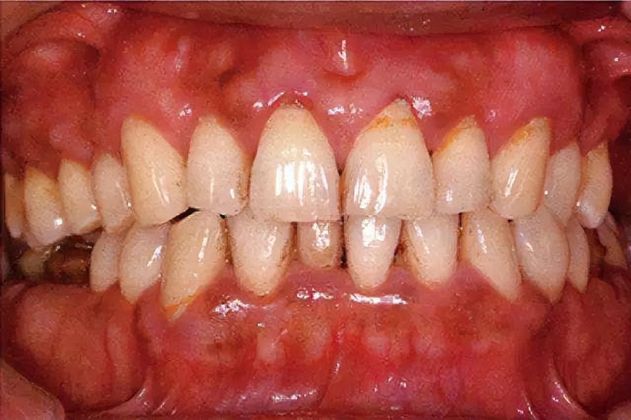 （牙齿酸软怎么办）牙齿酸软怎么办?口腔专家给出最有效的解决办法  第1张