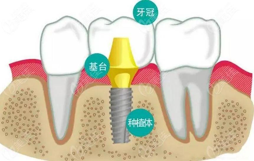 （种植牙齿）【杏林微科普】种植牙——人类的第三副牙齿  第2张