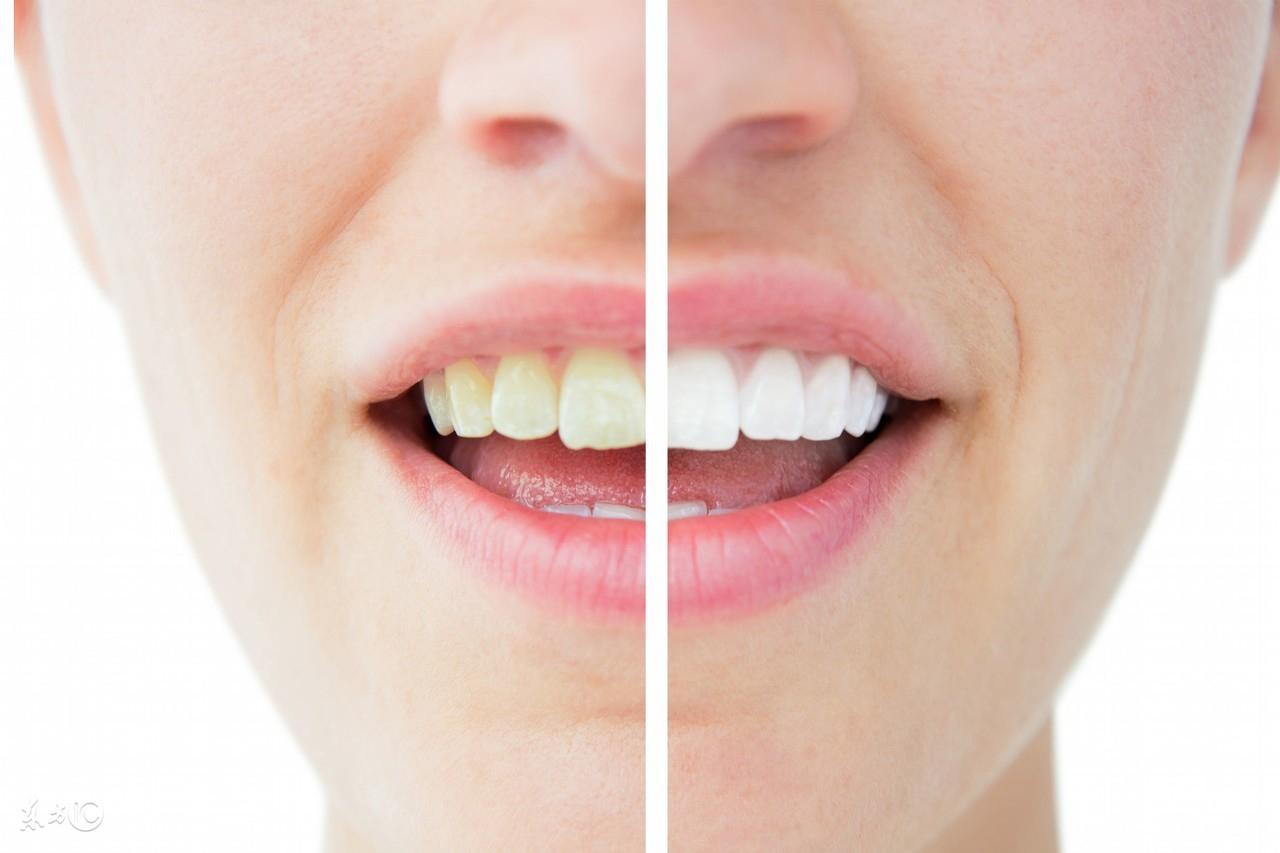 （贴面牙齿价格多少钱一颗）牙齿做贴面多少钱一颗?瓷贴面美白对牙齿有损害吗?  第2张