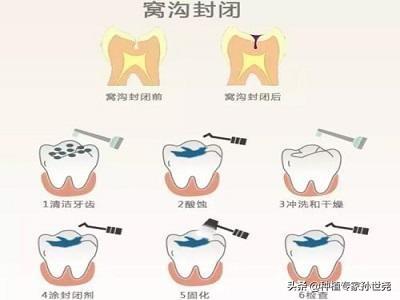 （儿童牙齿做窝沟封闭多少钱一颗）儿童做牙齿窝沟封闭多少钱?  第3张