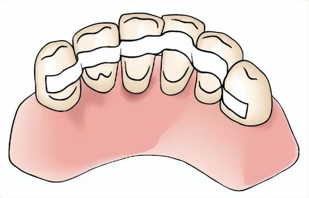（牙齿松动的治疗办法）牙齿松动还能固定吗?牙齿松动如何治疗呢?  第3张