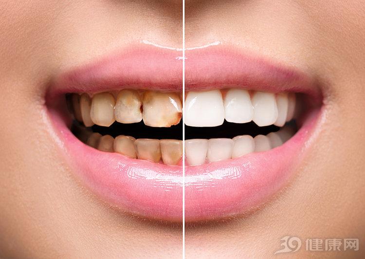 （牙齿如何变白）牙齿变黄，4个牙齿美白方法还你一口白牙  第2张