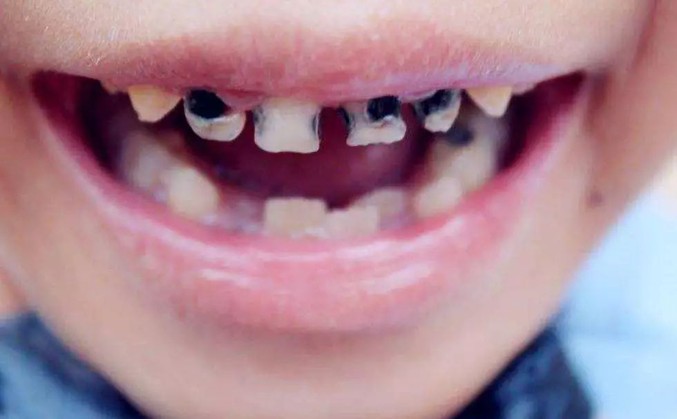 （小孩牙黑是什么原因引起）孩子满嘴“小黑牙”，不是糖果惹的祸，而是与这3个原因相关  第3张