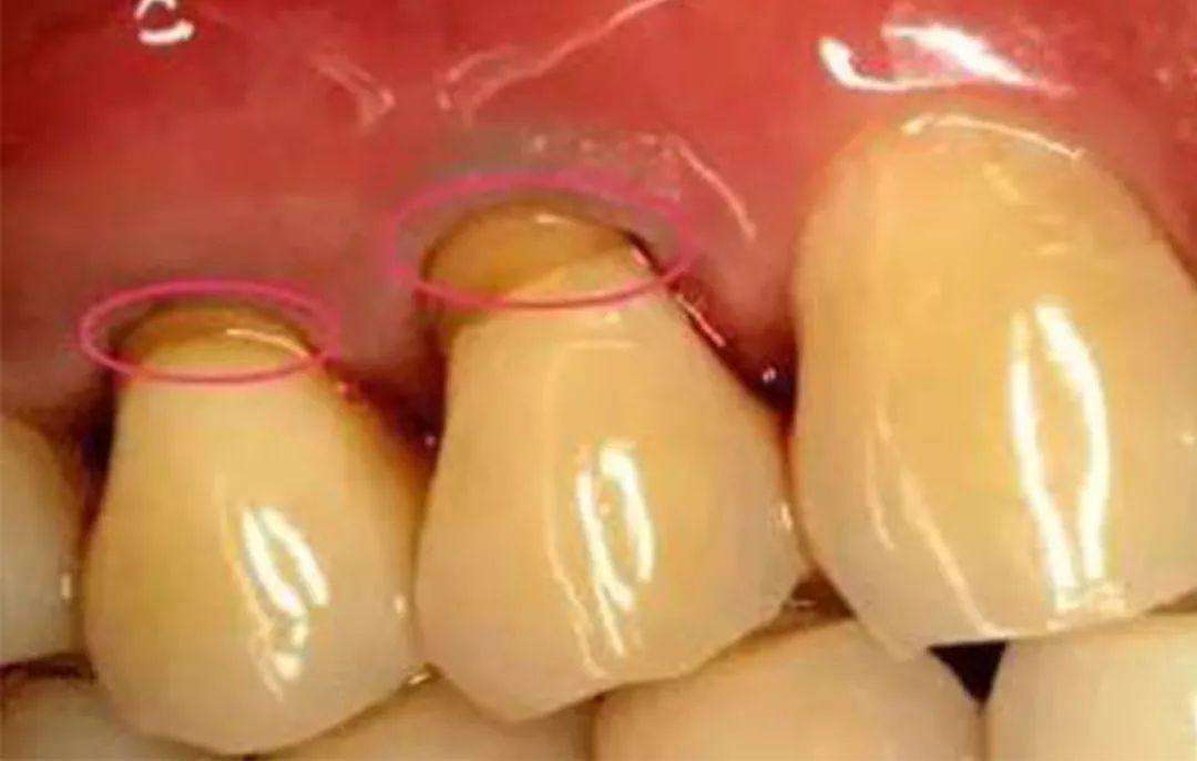 （牙齿酸软怎么办）牙齿酸软怎么办?口腔专家给出最有效的解决办法  第2张